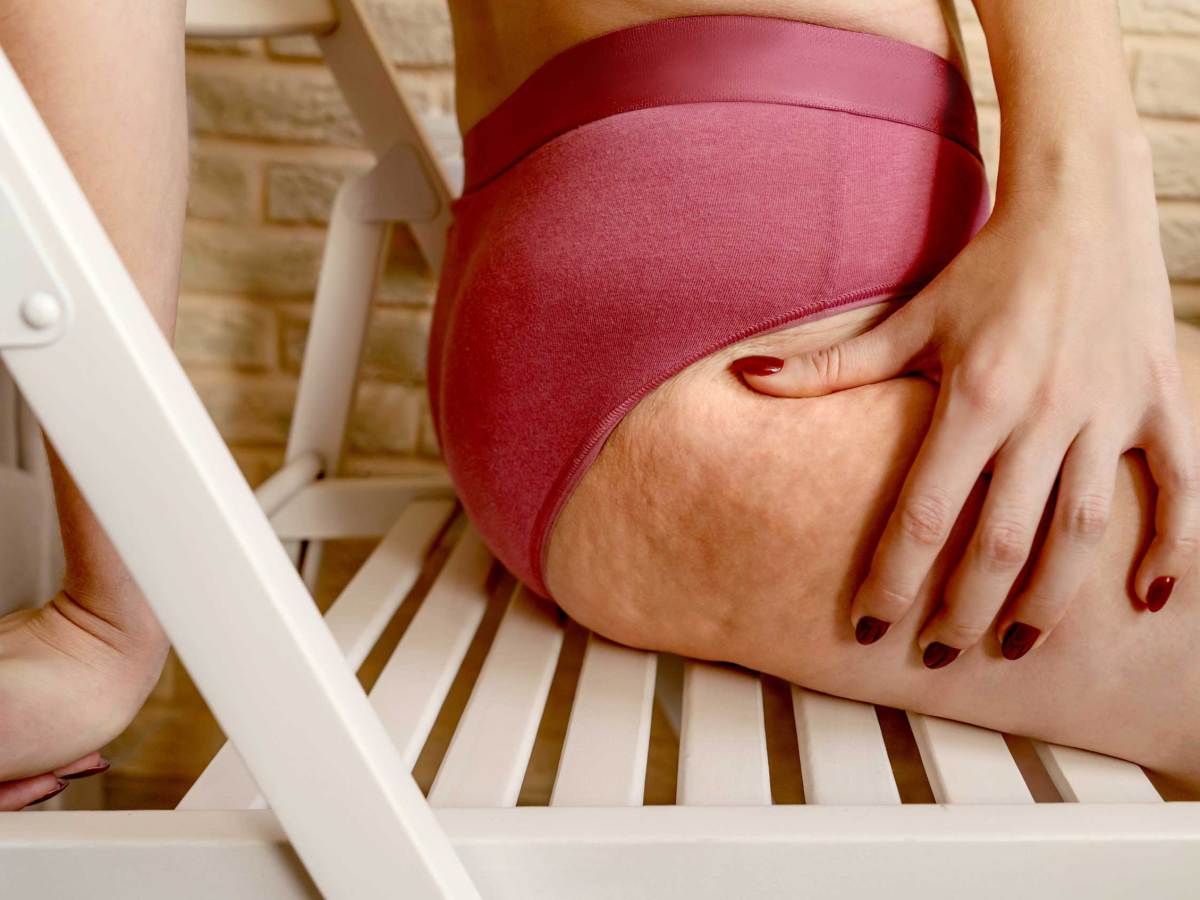 Nahaufnahme von Cellulite am Bein.