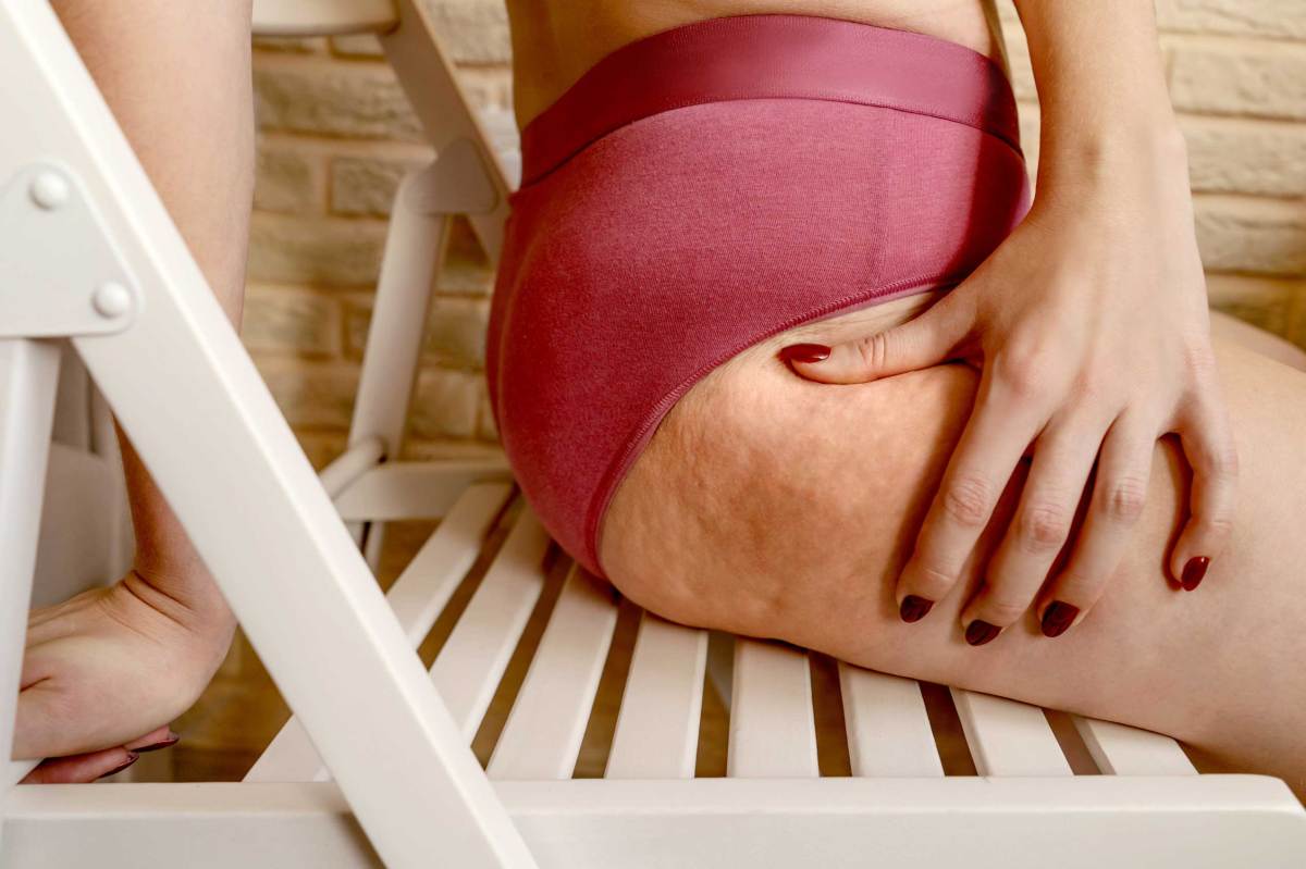 Nahaufnahme von Cellulite am Bein.