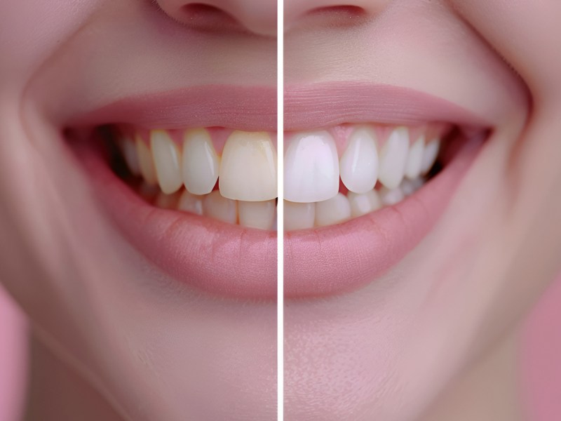 Side by Side Vergleich von einer Person mit gelblichen und weißen Zähnen.